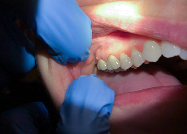 Best Emergency Treatment for Dental Infections or Abscesses in Iowa City, IA